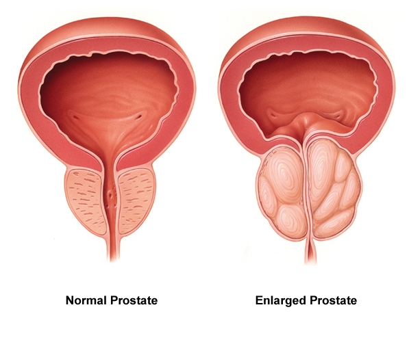 Normal-vs-enlarged-prostate Normal-vs-enlarged-prostate