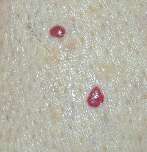 Cherry Angioma Pictures : Cherry Angiomas - Finesse Skin Clinic : In ...